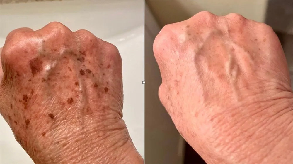 After Treatment
