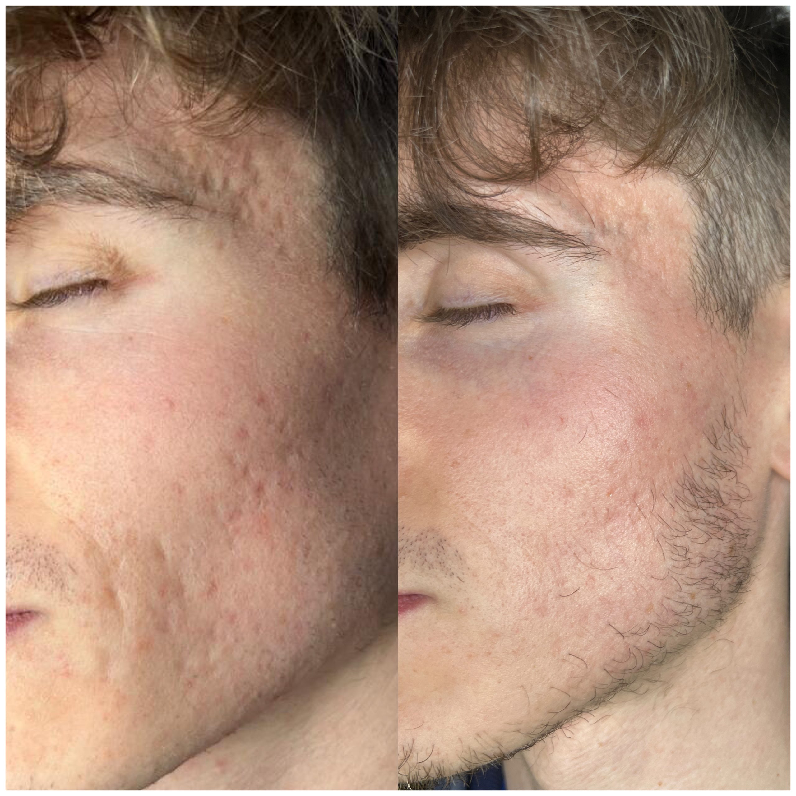 After Treatment
