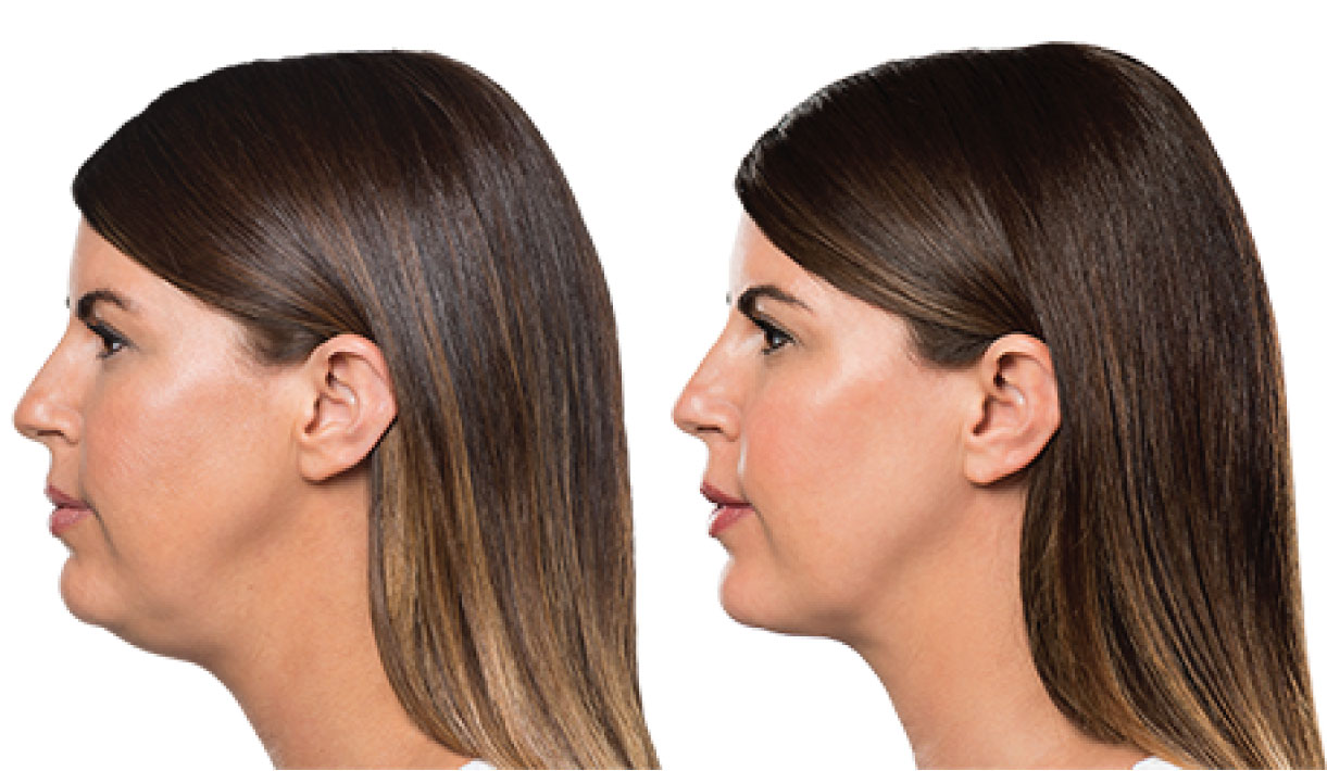 Double chin treatment aftercare