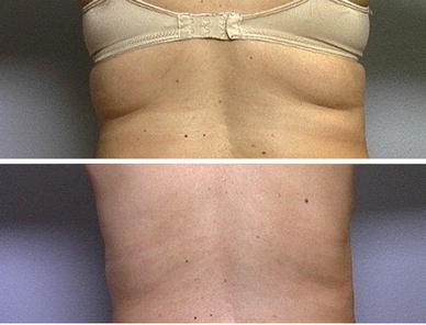 Draining PPC treatment aftercare