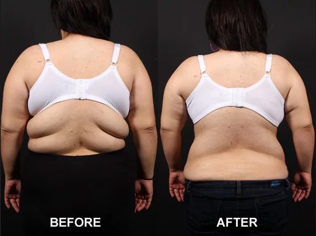 Fat deposits treatment aftercare