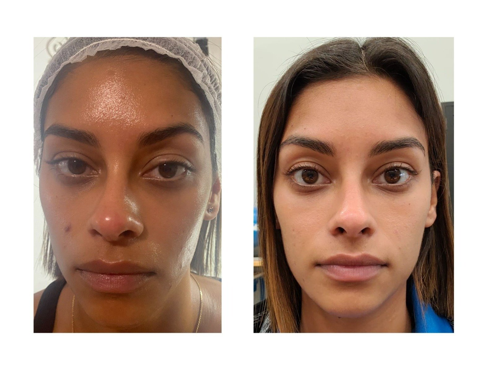 After Treatment
