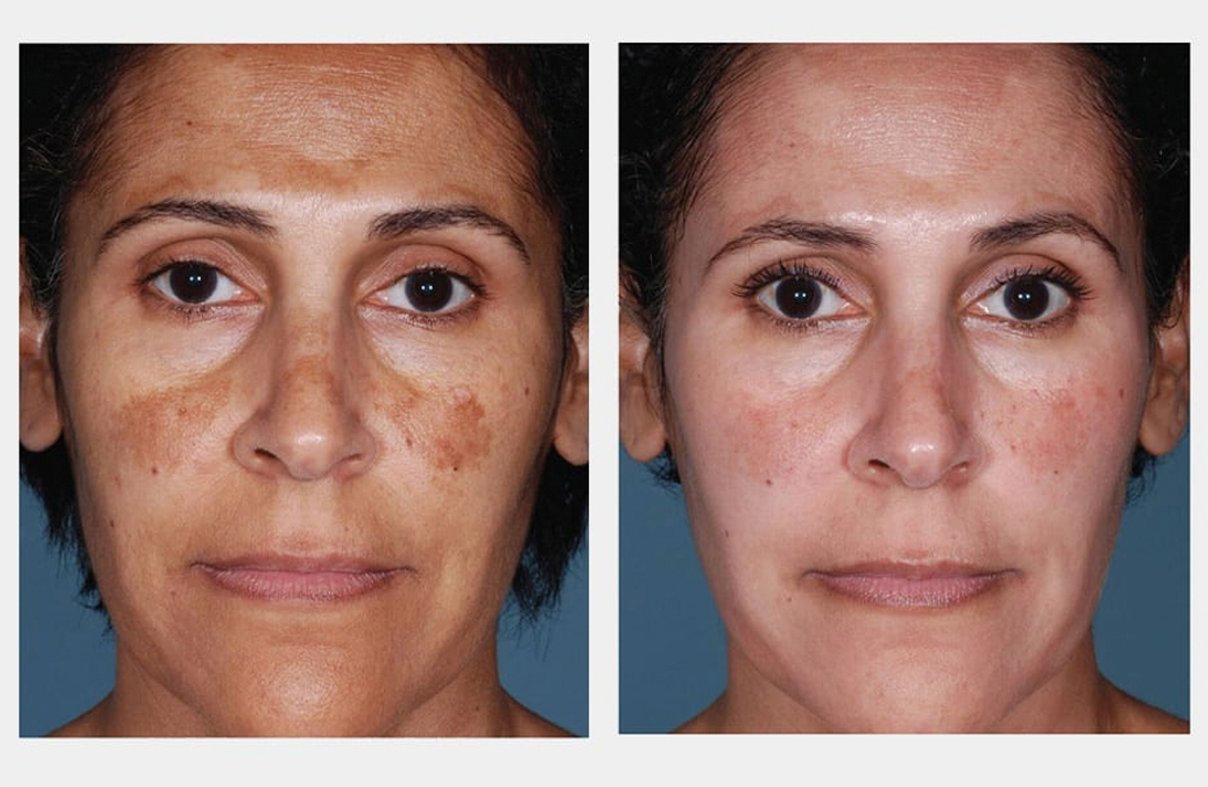 Hyperpigmentation treatment aftercare