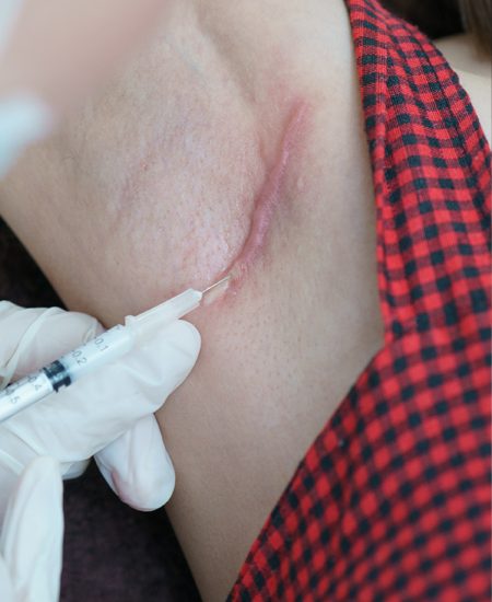 Consultation for Hypertrophic Scar