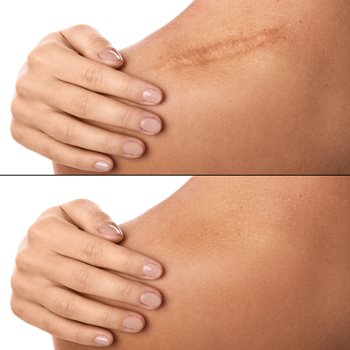 After Treatment Care