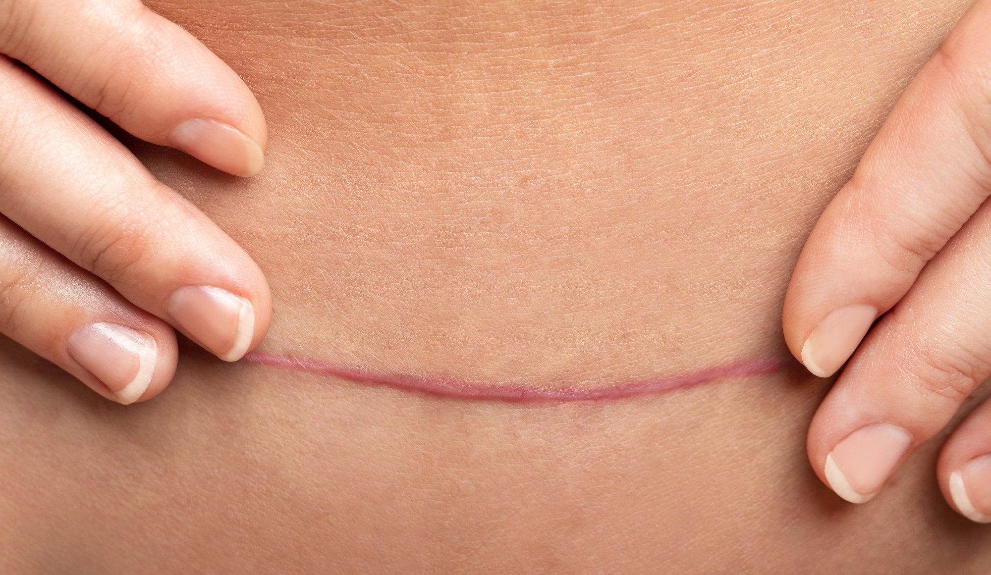 Hypertrophic Scar Example