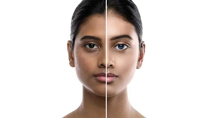 After laser whitening treatment