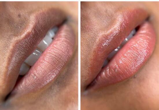Lip lightening treatment aftercare