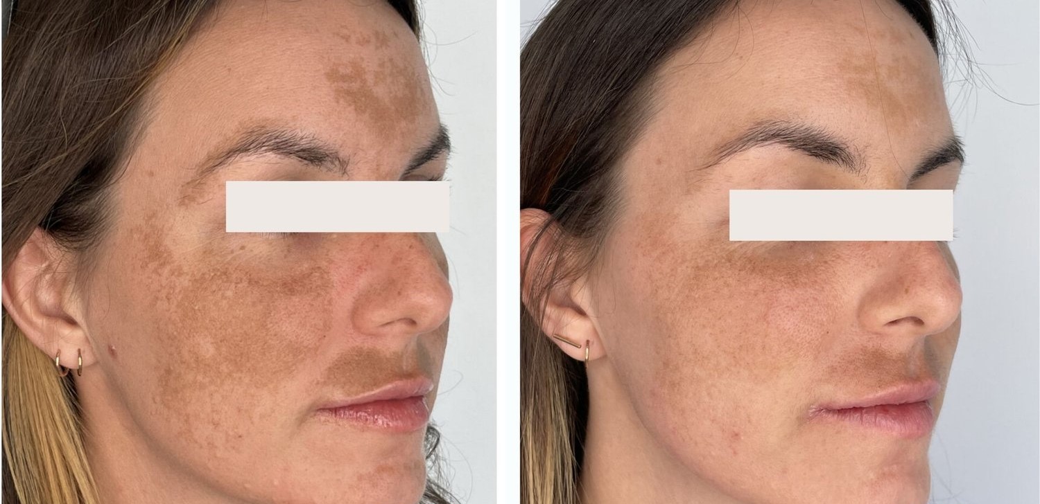 Melasma treatment aftercare