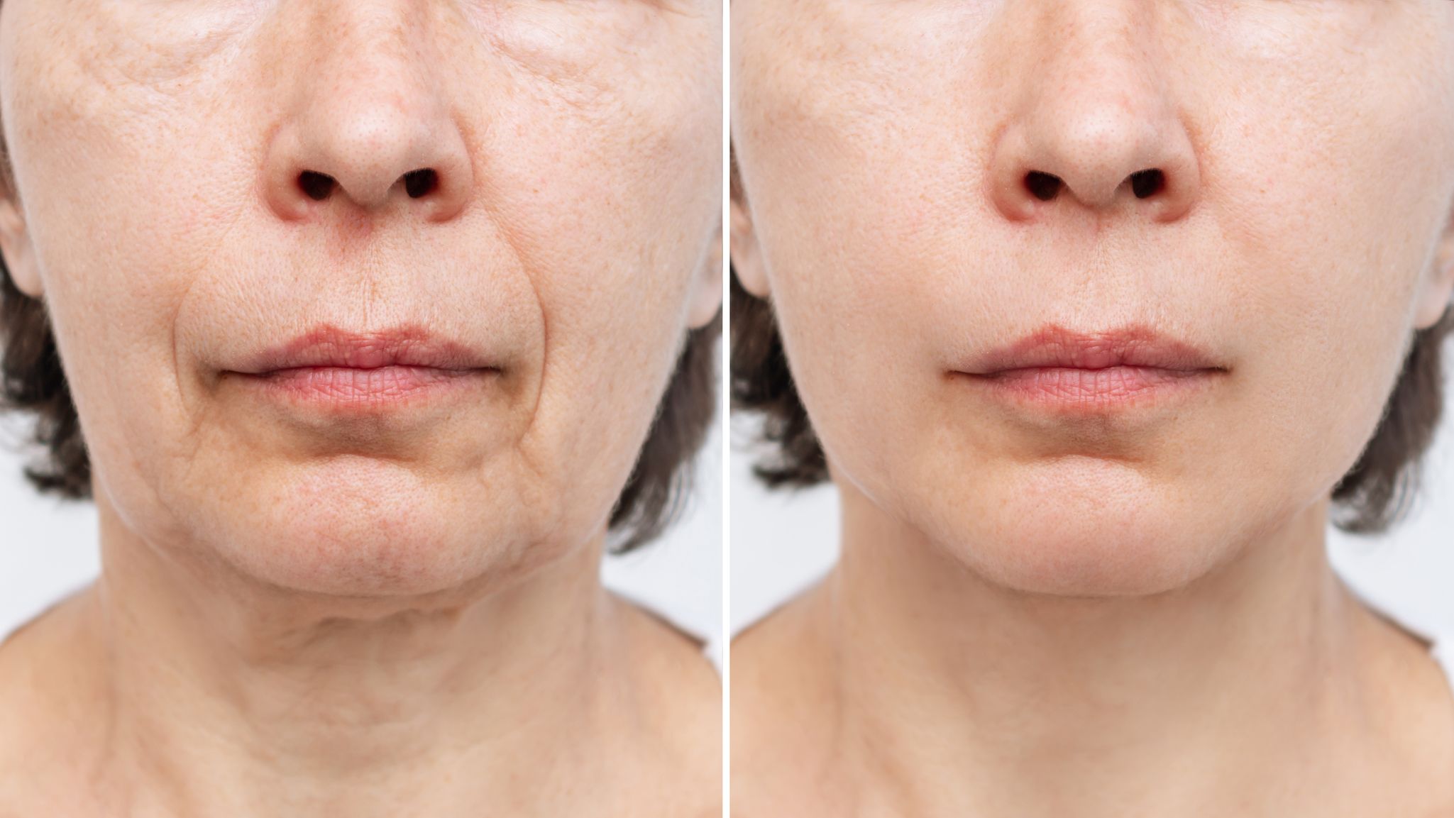 Sagging skin treatment aftercare