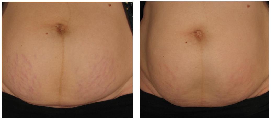 Stretch marks treatment aftercare