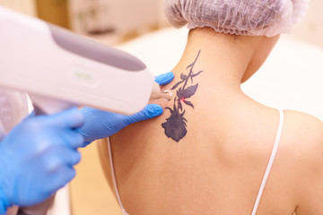 Tattoo removal treatment during
