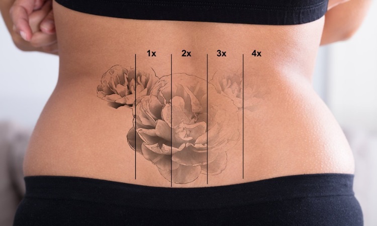 Tattoo removal treatment aftercare
