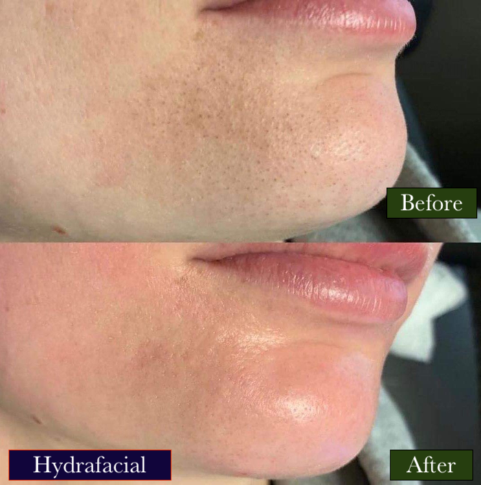 HydraFacial Treatment