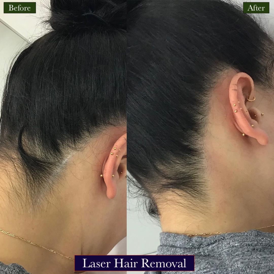 Laser Hair Removal