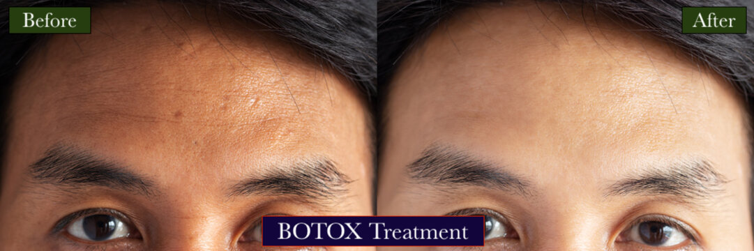 BOTOX Treatment