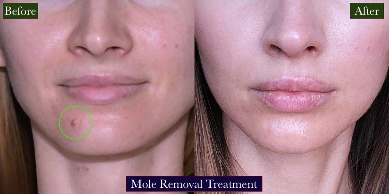Mole Removal Treatment