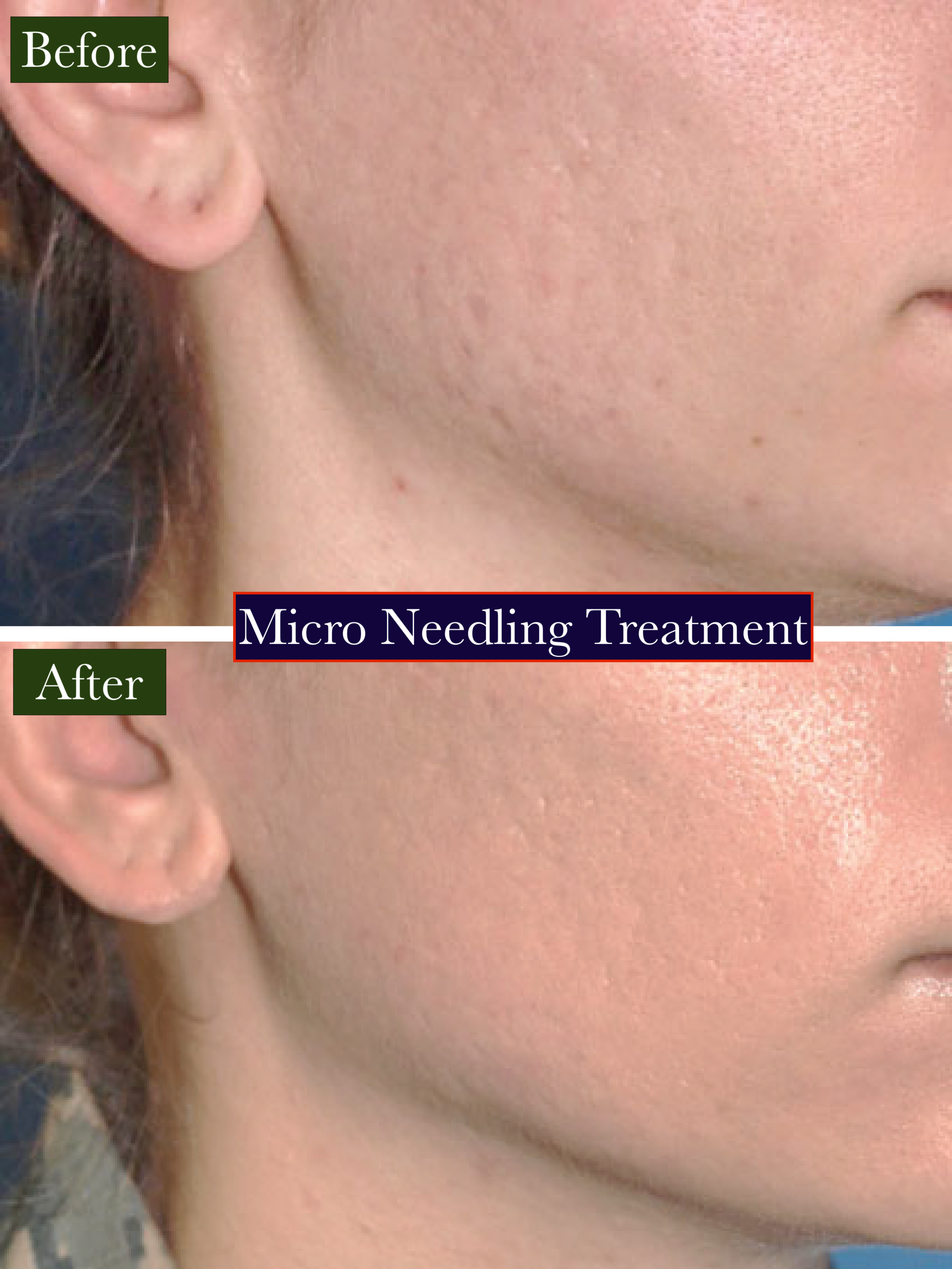 Micro needling Treatment