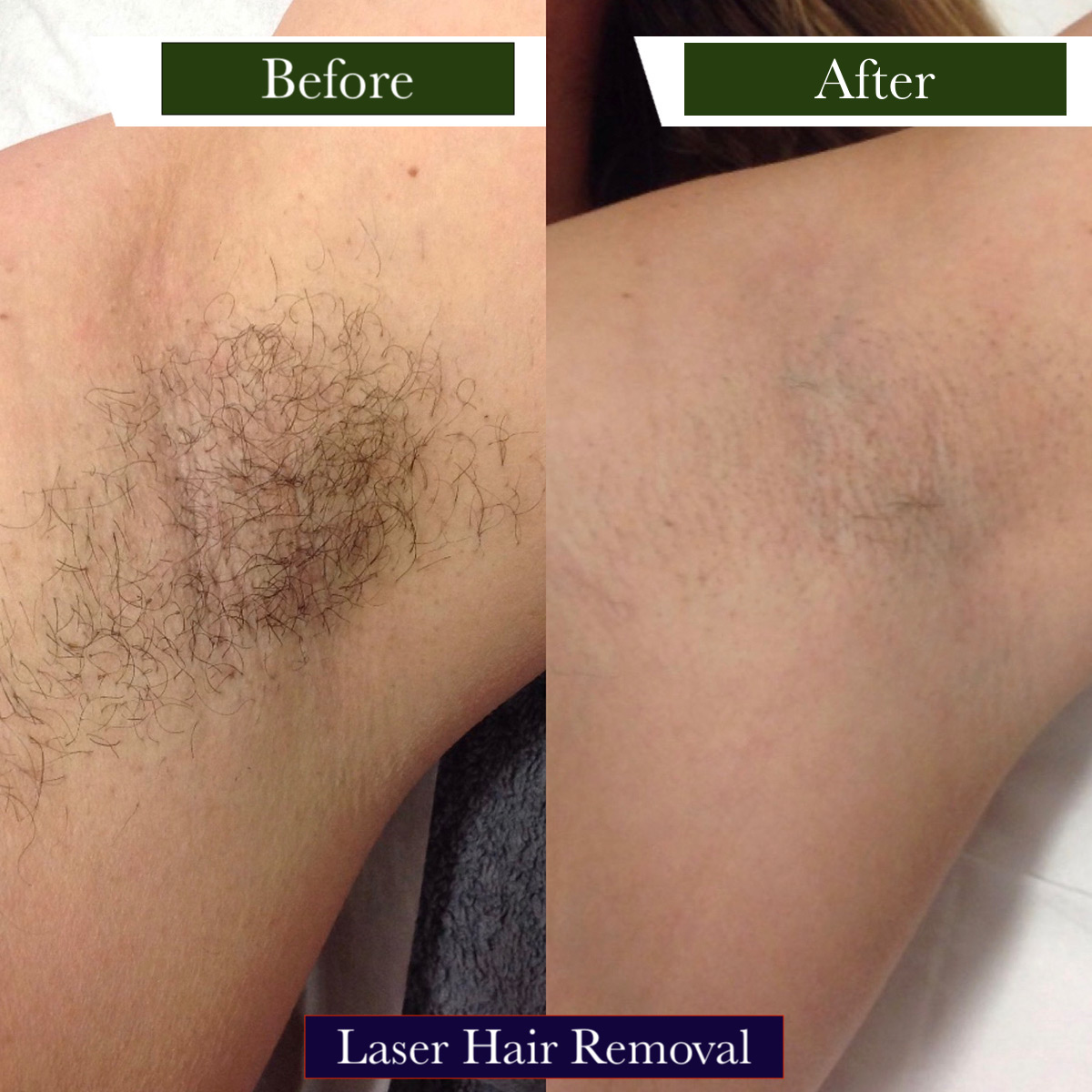 Laser Hair Removal