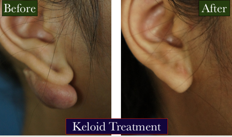 Keloid Removal Treatment