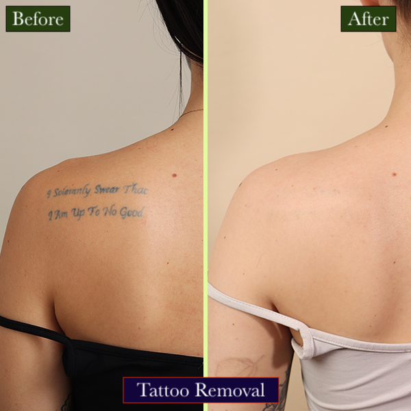 Tattoo Removal Treatment