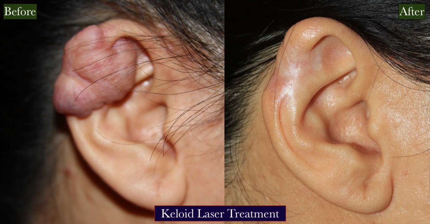 Keloid Laser Treatment