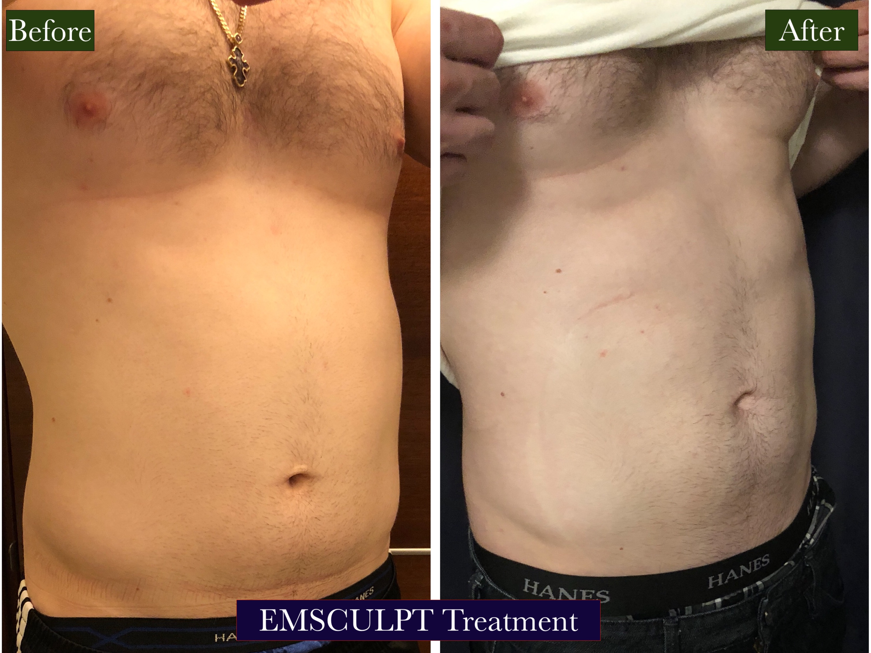 Emsculpt Treatment