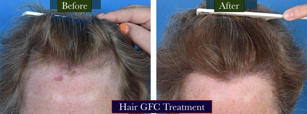 Hair GFC Treatment