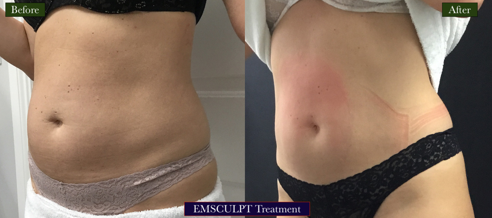 Emsculpt Treatment