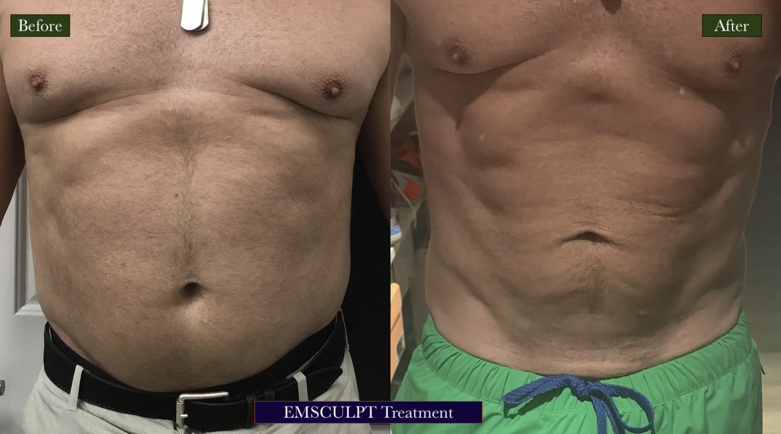 Emsculpt Treatment