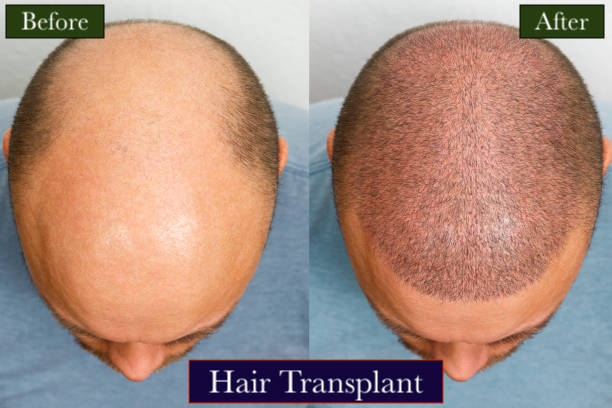 Hair Transplant